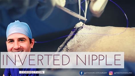 newly inverted nipple|Inverted nipple